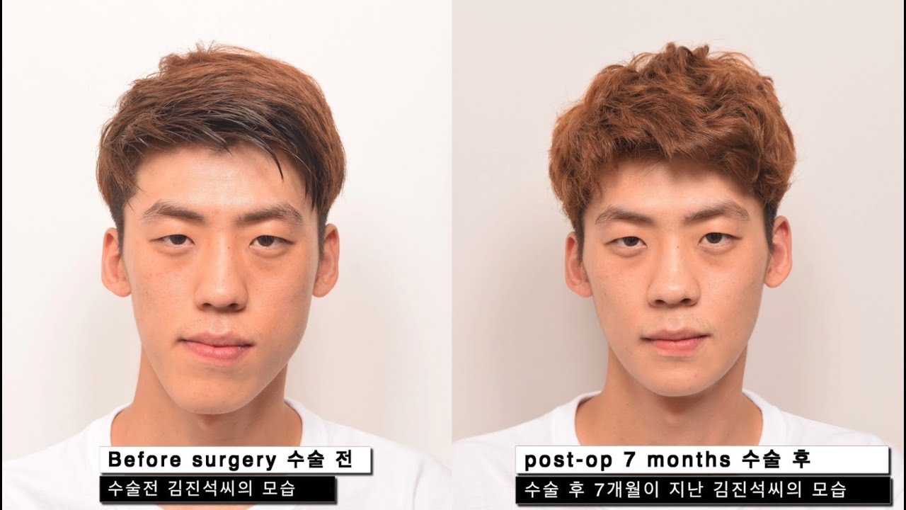 Facial Asymmetric Double Jaw Surgery Review (Post OP 7 Months)_EU Korea