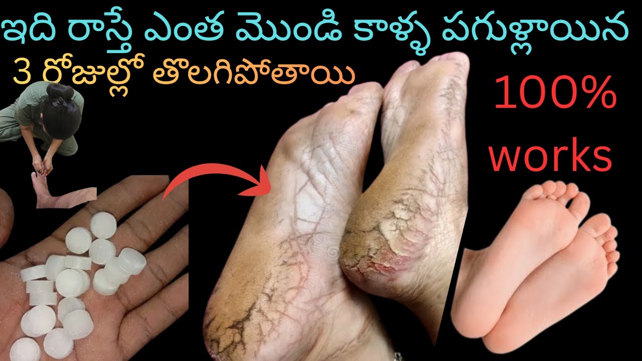 🔥 ఎంత భయంకరమైన కాళ్ళ పగుళ్ళయిన 3 రోజుల్లో తొలగిపోతాయి #Remove Crack Heels #Soft feets // # VSatrichi