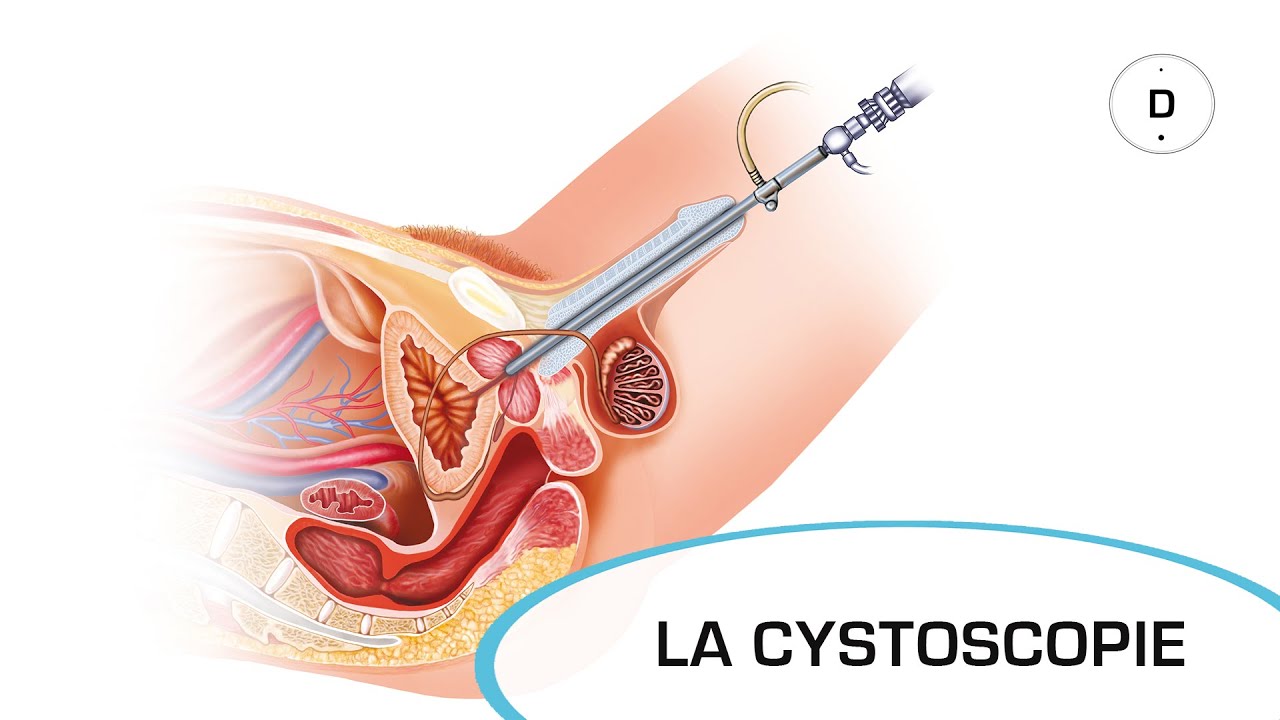 La cystoscopie - Examens m&eacute;dicaux