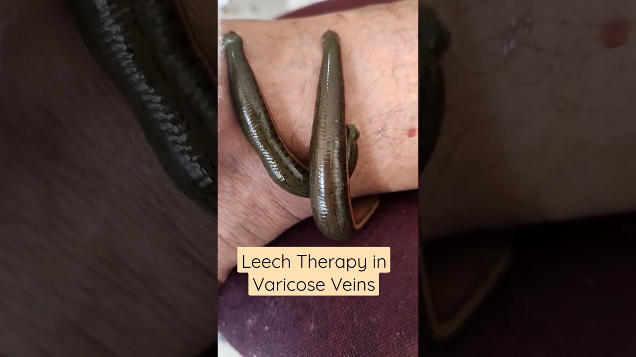 Leech Therapy in Varicose Veins #leechtherapy #varicoseveinstreatment