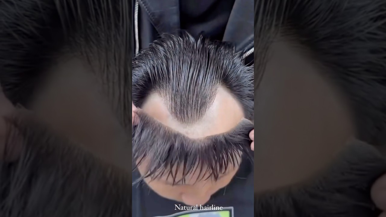#Frontline hair patch for men&rsquo;s#hair patch centre in Kolkata#best salon in Kolkata #human hair patch
