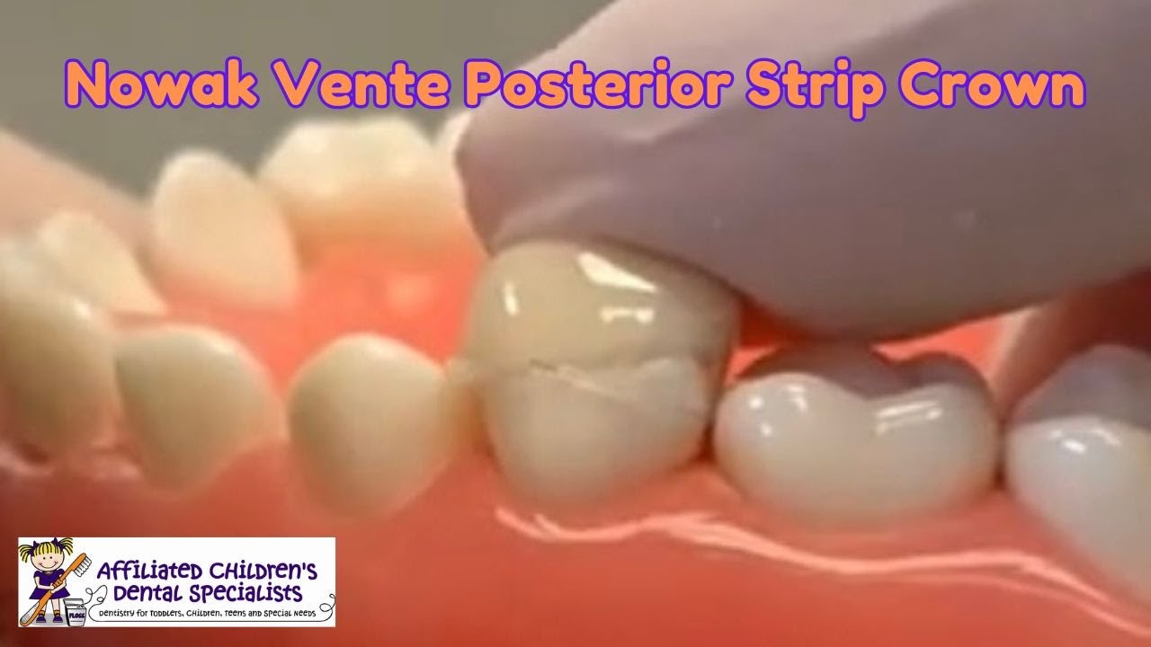 Nowak Vente Posterior Strip Crown Atraumatic Restorative Treatment Tutorial