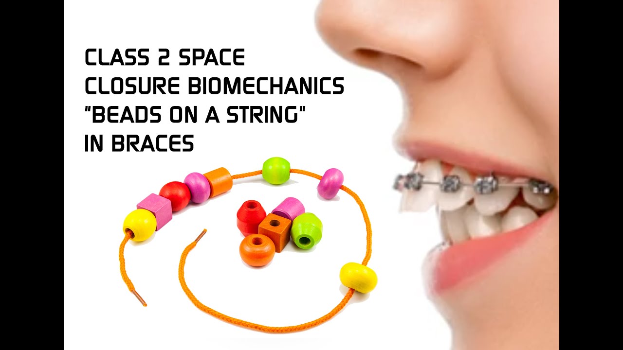 Biomechanics for a Class 2, Class II Extraction Space Closure- 