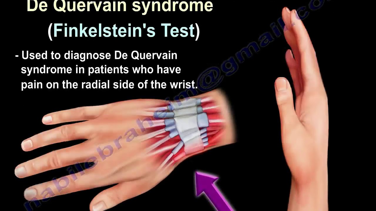 De Quervain Syndrome Test - Everything You Need To Know - Dr. Nabil Ebraheim