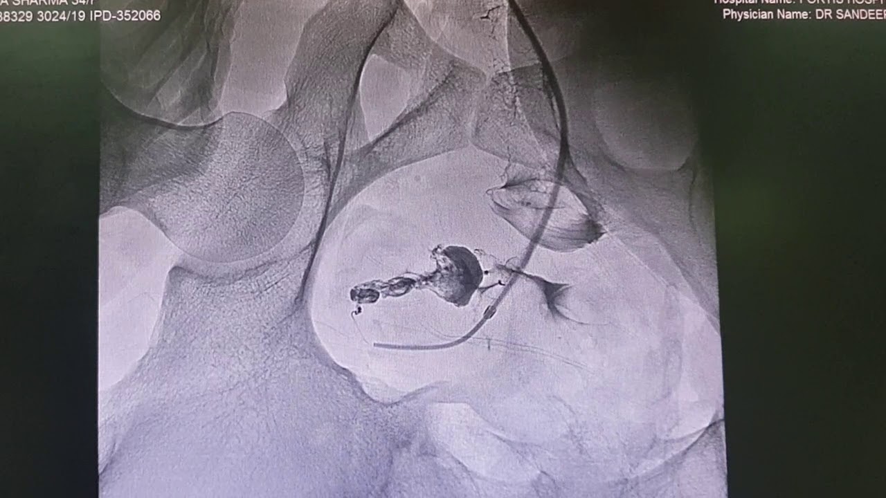 Infertility treatment by balloon tuboplasty of fallopian tube
