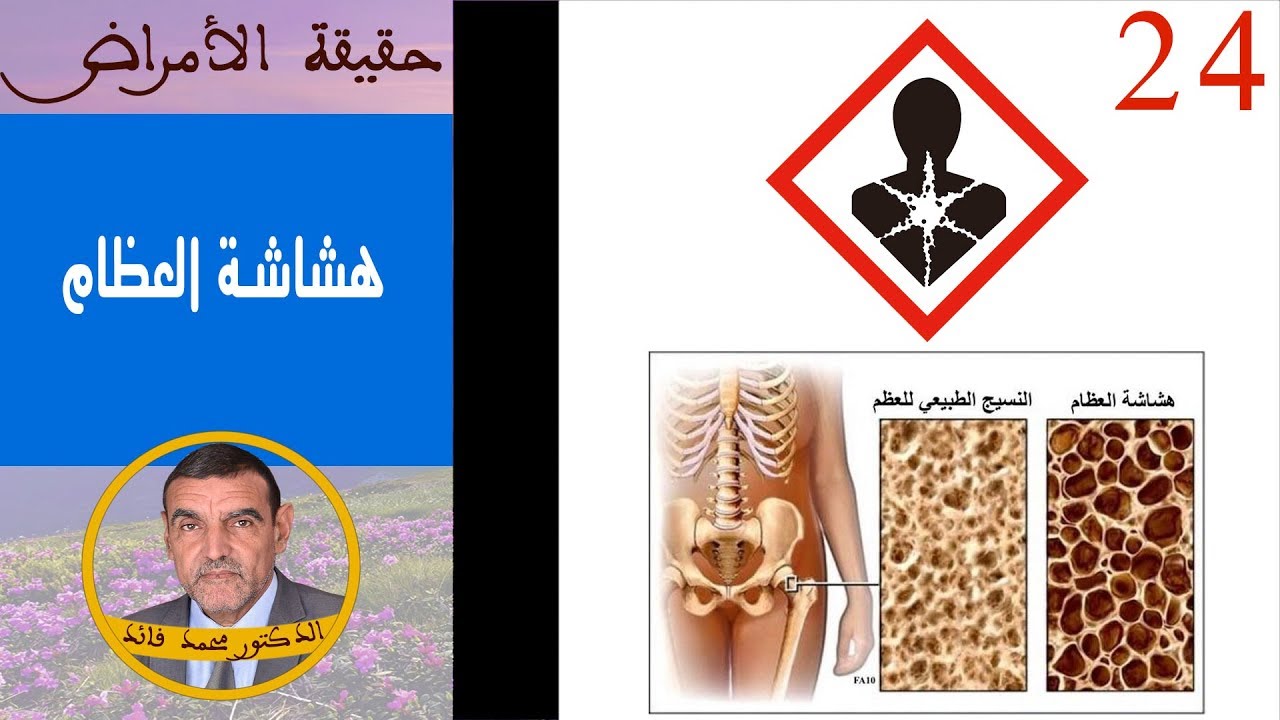 هشاشة العظام  | الدكتور محمد فائد