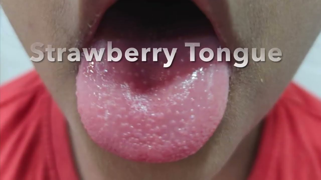 Scarlet Fever Symptoms and Treatment | What is Scarlet Fever | Strawberry Tongue in Scarlet Fever