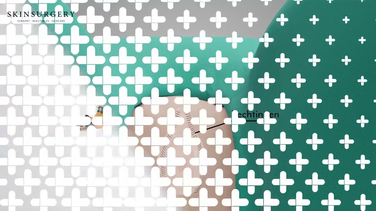 Schaamlipcorrectie | Illustratieve video | Skin+Surgery