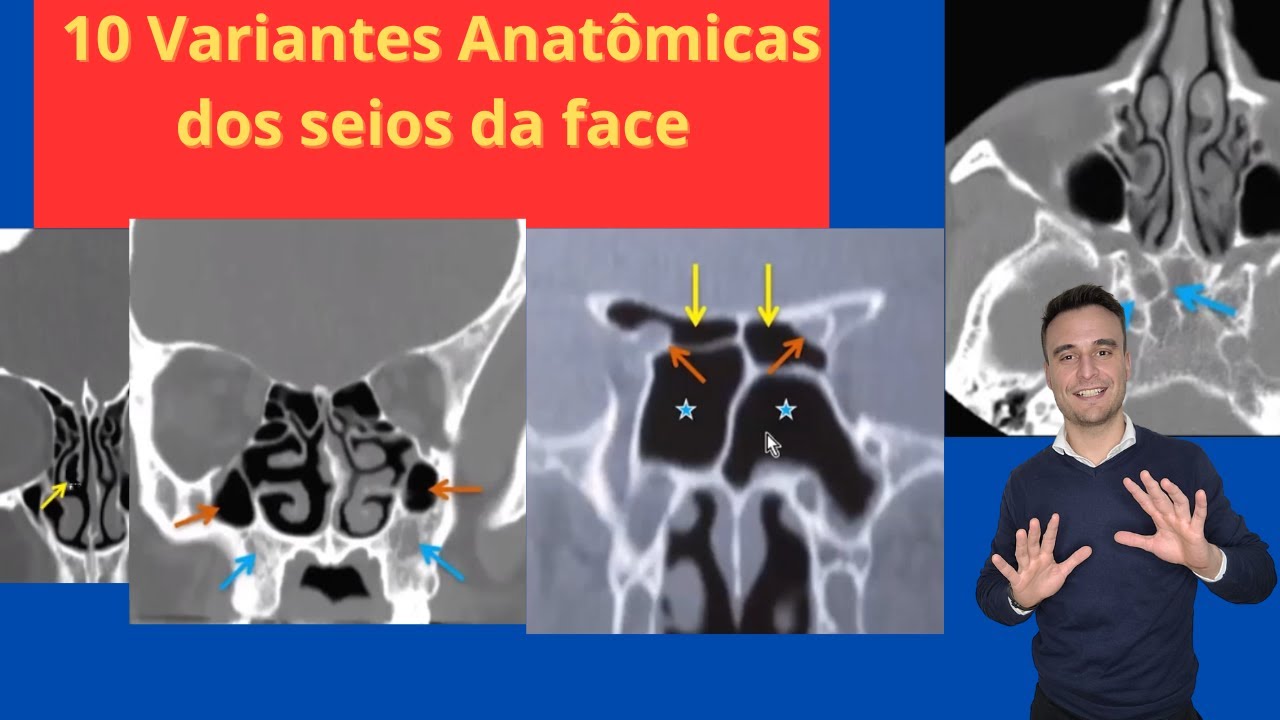 Desvio de septo, concha bolhosa. Onodi e outras variantes dos seios da face na tomografia