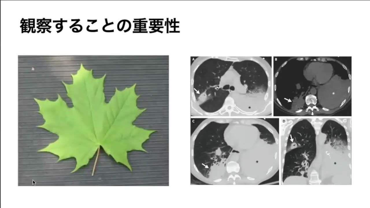 【NEJM MGH-CPC 勉強会】75歳男性　亜急性肺炎