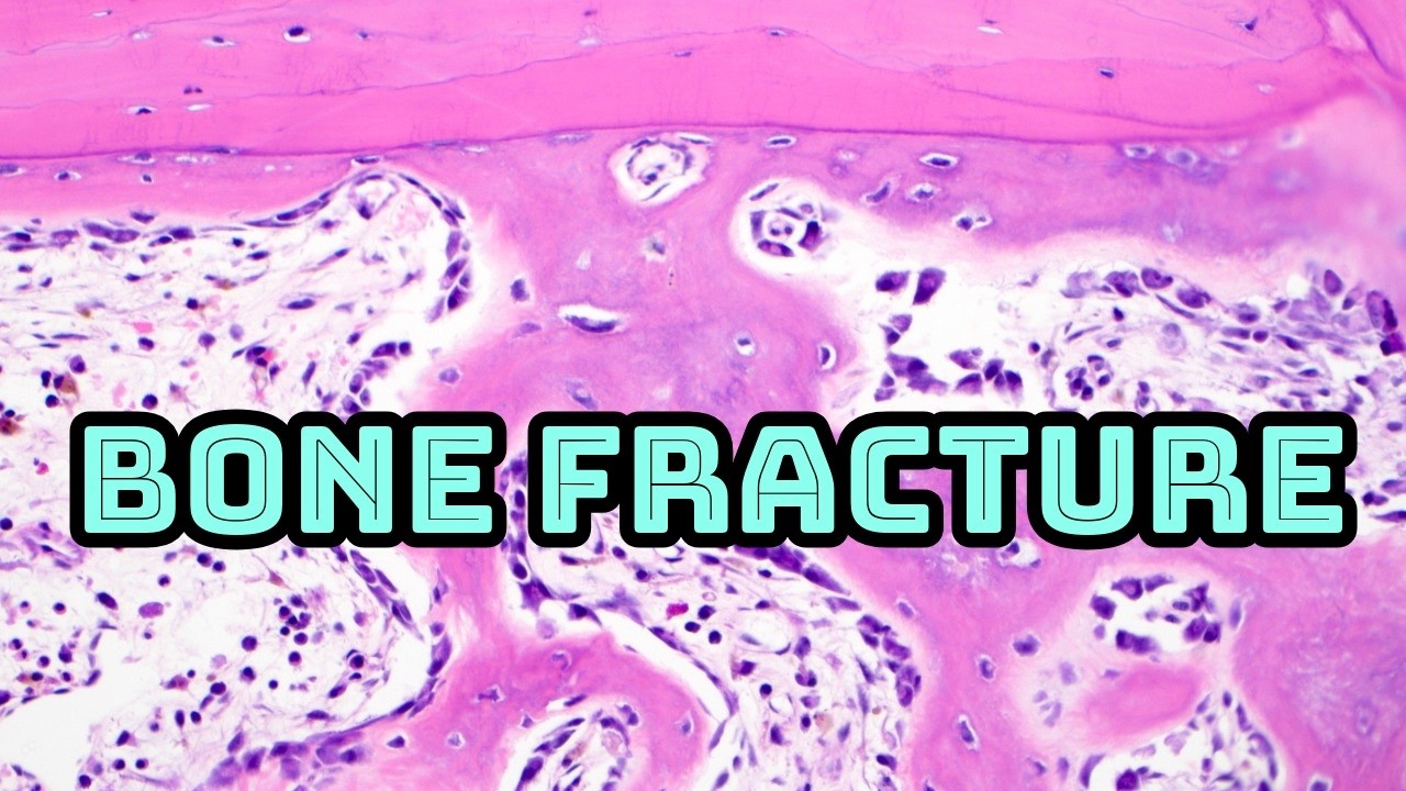 Bone fracture healing under microscope (spine fracture osteoporosis lamellar & woven bone pathology)