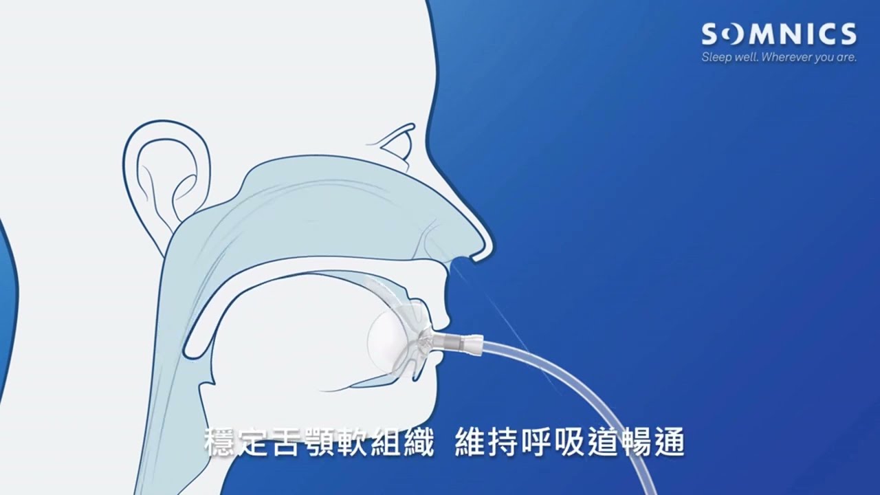 How to Use iNAP｜iNAP負壓呼吸器快速使用指南
