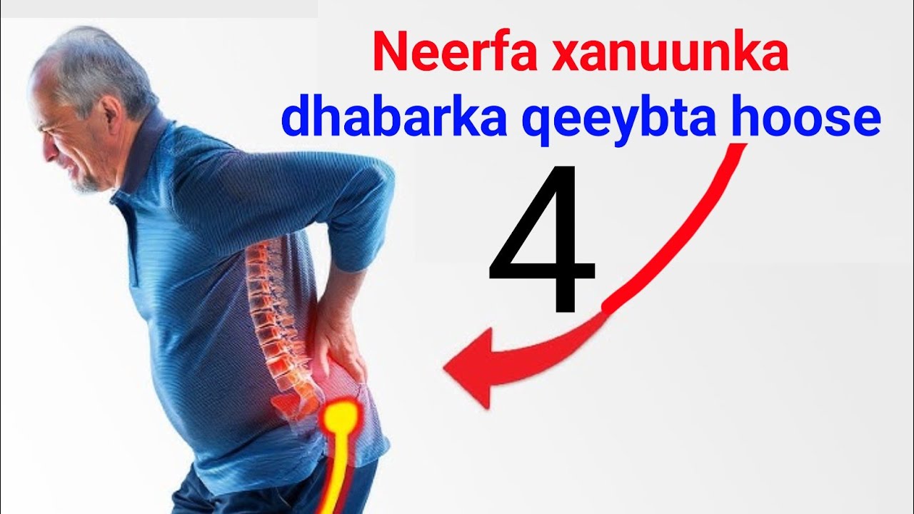 Xanuunka Neerfaha dhabar qeeybta hoose 4-qaab oo loo daaweeyo iyo waxa sababo