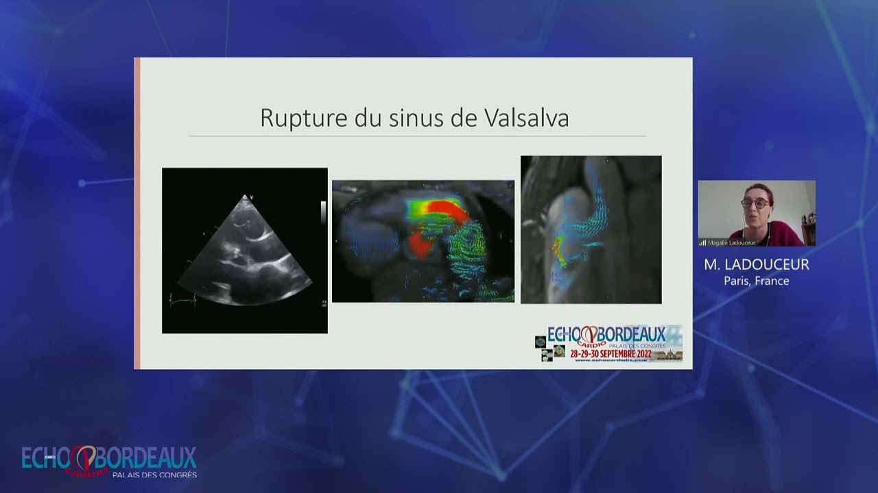 Que rechercher devant un VG dilaté (de la CIV à la CMD en passant par le canal artériel) ?