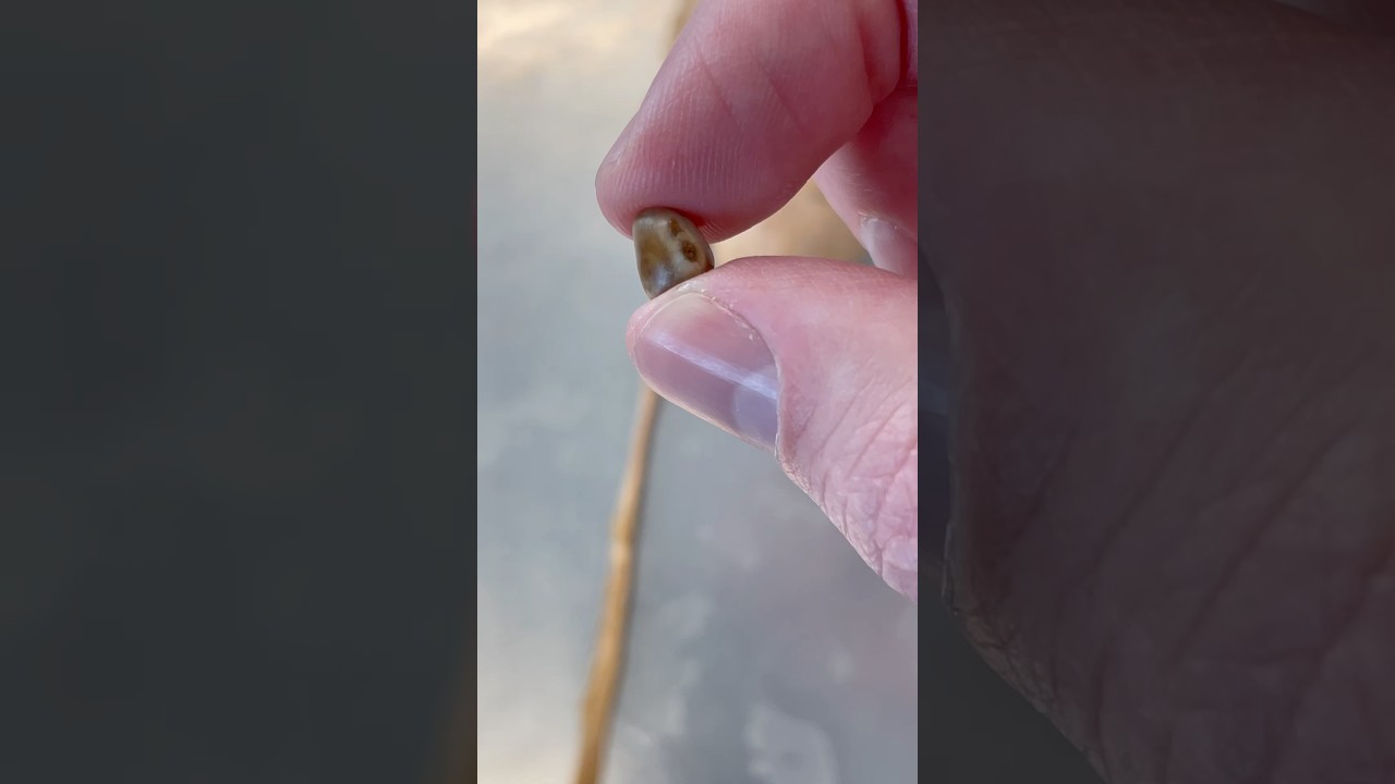 Look At This Real Kidney Stone!