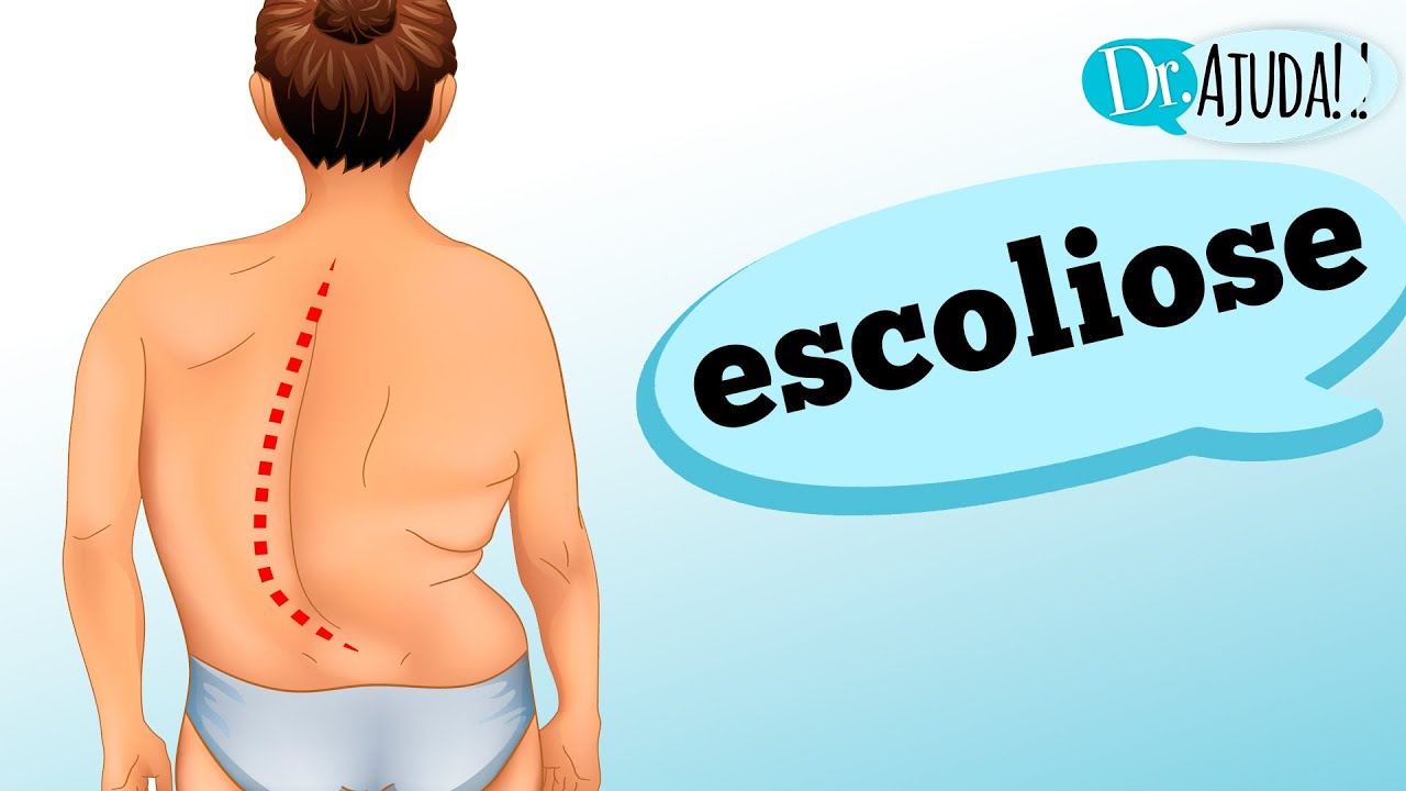 COLUNA TORTA: como reconhecer a ESCOLIOSE e suas características?