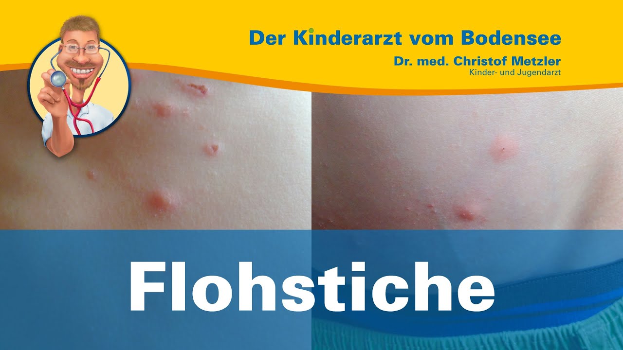 Flohstiche, juckende Punkte in einer Reihe - Der Kinderarzt vom Bodensee