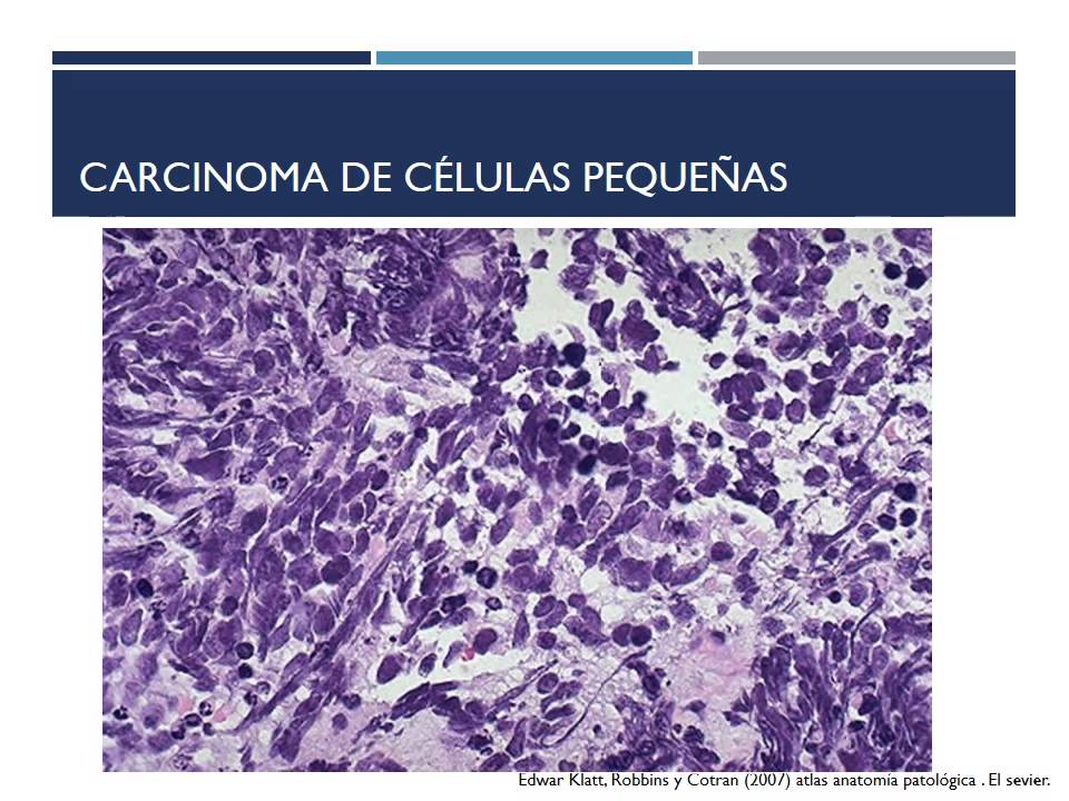 Cancer de pulmón