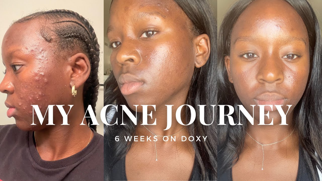 CLEARING HORMONAL ACNE With Doxycycline