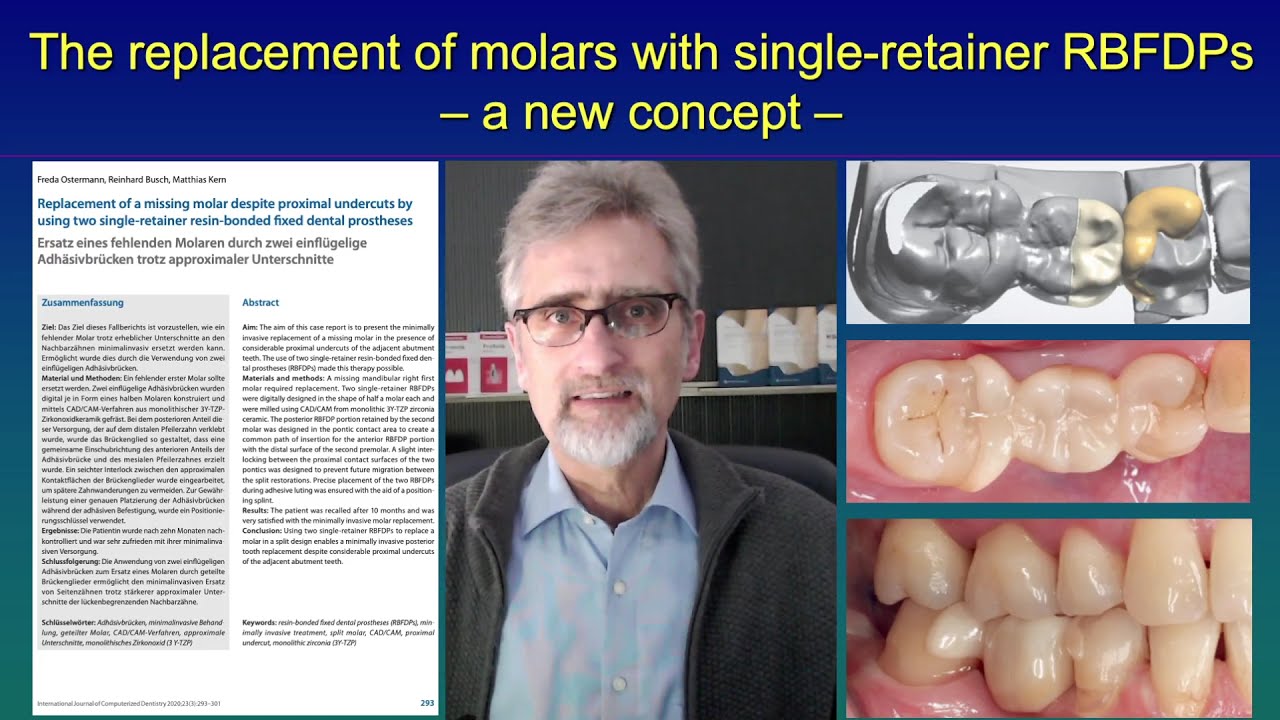 The replacement of molars with two single-retainer resin-bonded bridges - a new concept -