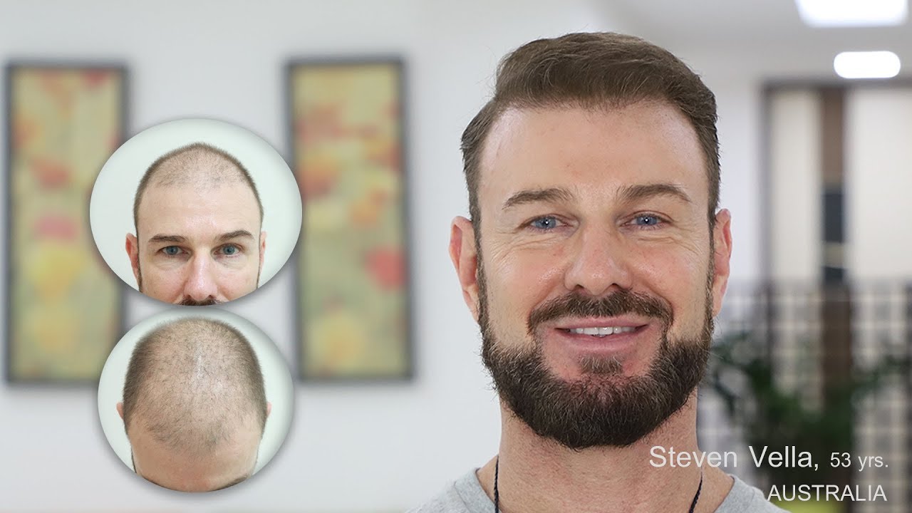 Hair Transplant Makeover at Kamol Cosmetic Hospital