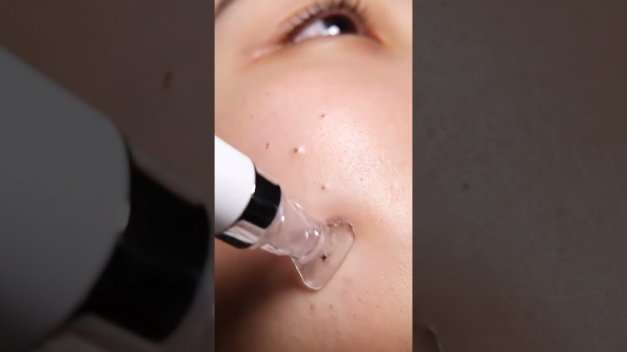&ldquo;Oddly Satisfying Vacuum Facial 💨 | Blackhead Removal Close-Up ASMR&rdquo;