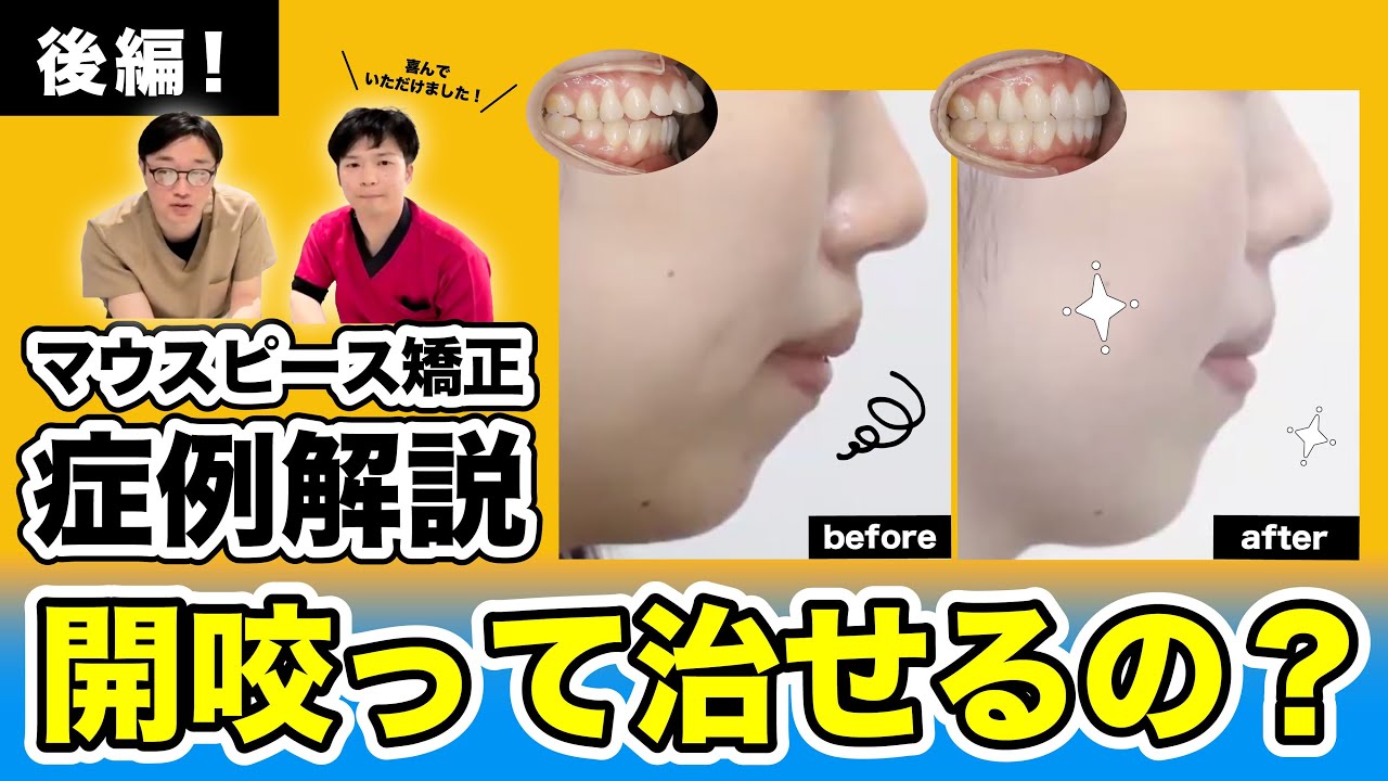 【後編】マウスピース矯正で開咬って治せるの？