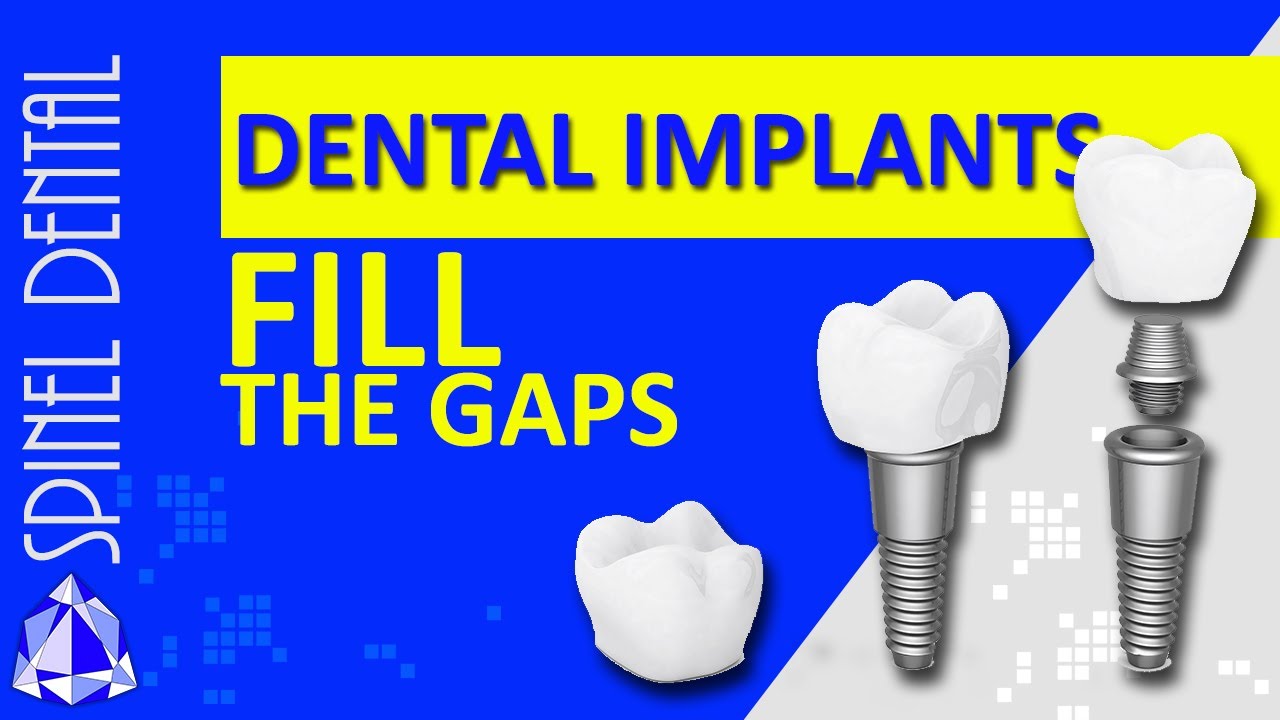 Dental Implants | All you need to know! 2020 | Dentist in Hamilton