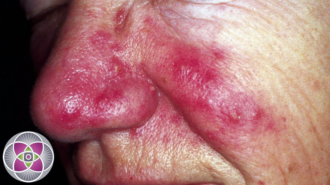 Laser Treatment for Rosacea & Skin Redness