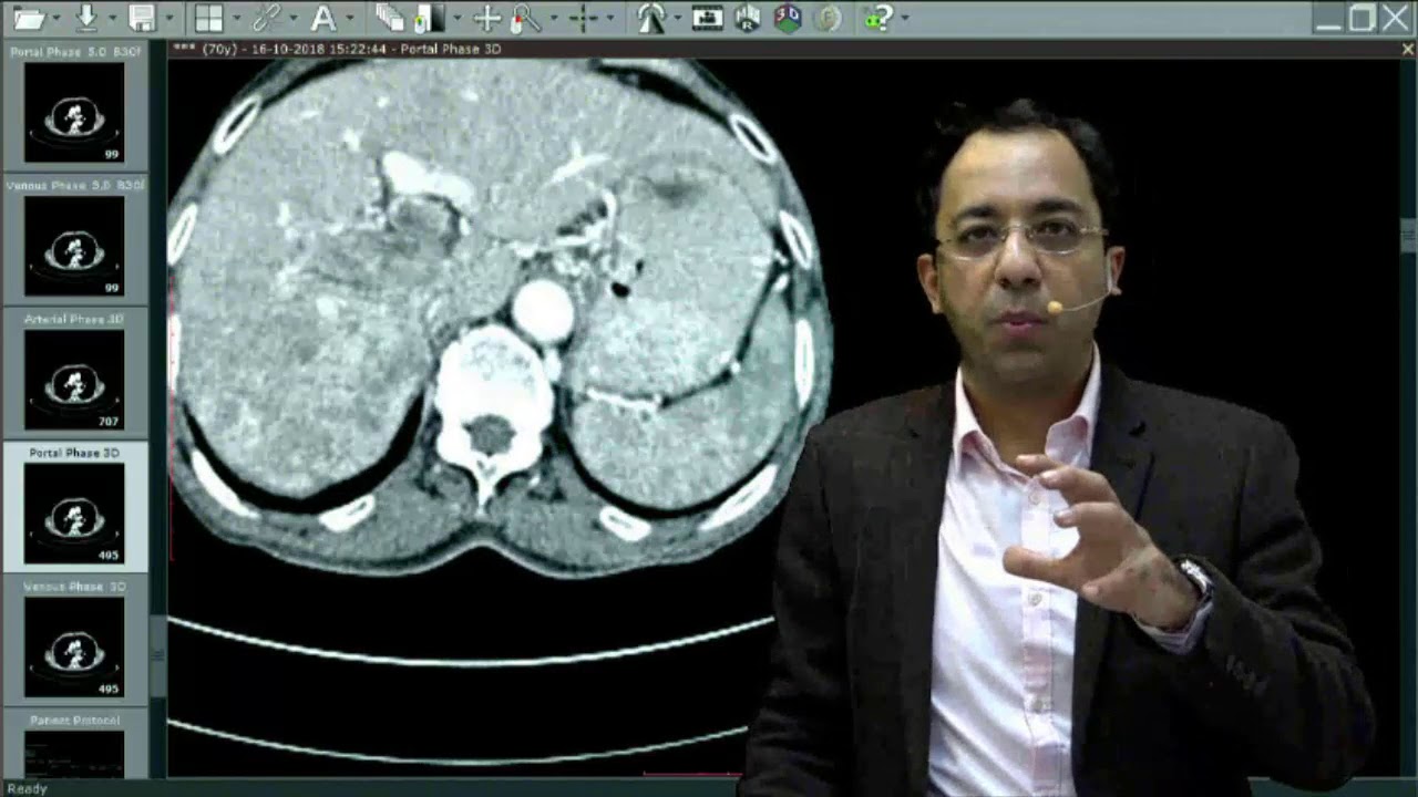 #HCC #TriplePhase #MDCT #DAMS #Medicine #Unplugged