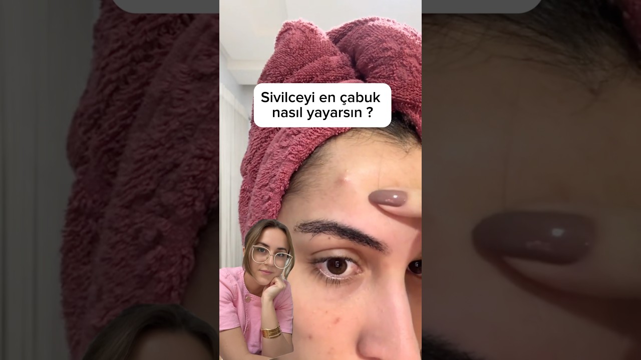 Sivilceyi en &ccedil;abuk nasıl yayarsın?
