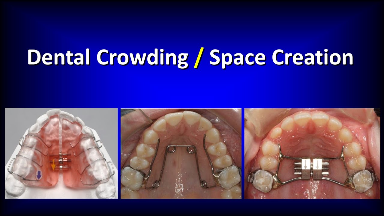 Dental crowding / Space Creation