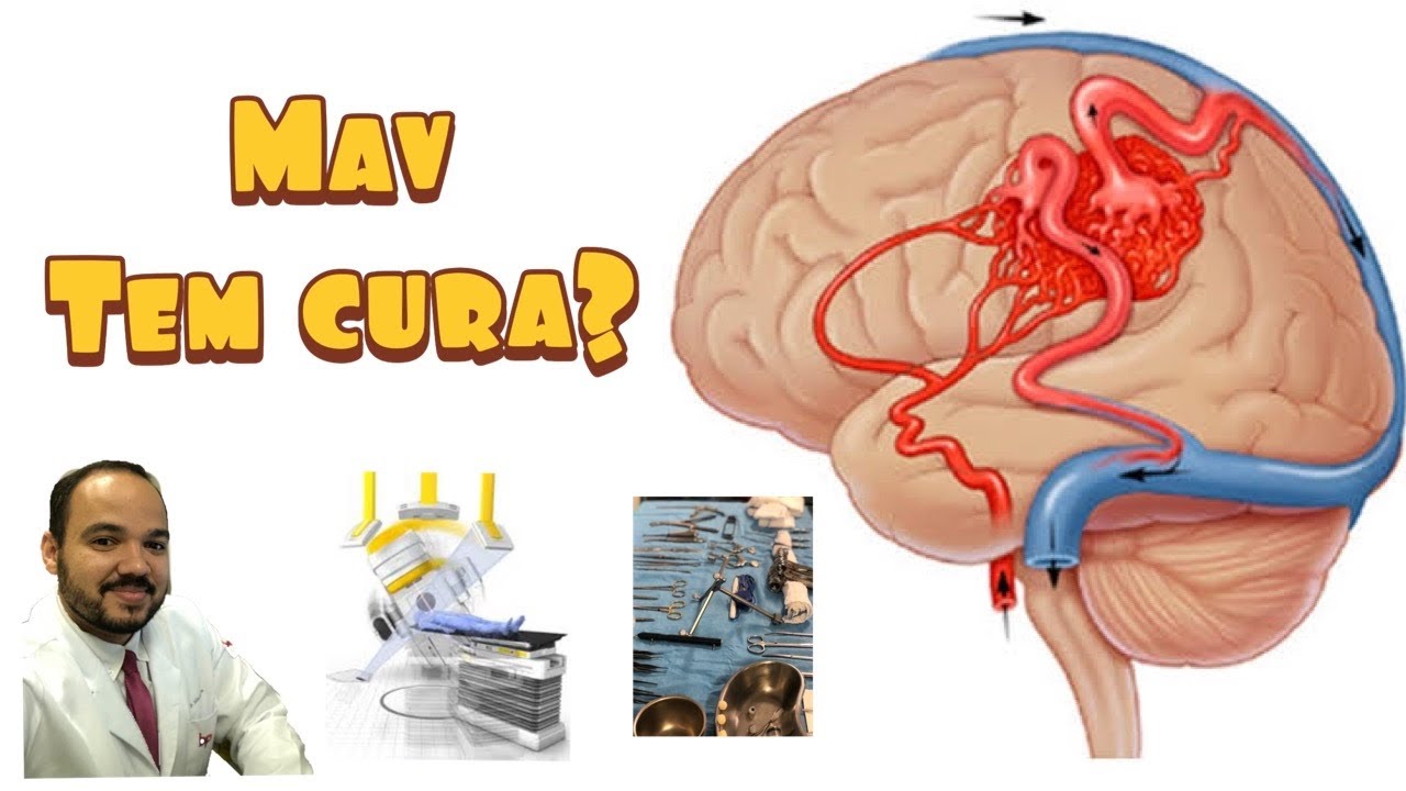 Malformação arteriovenosa (MAV)  tem cura?