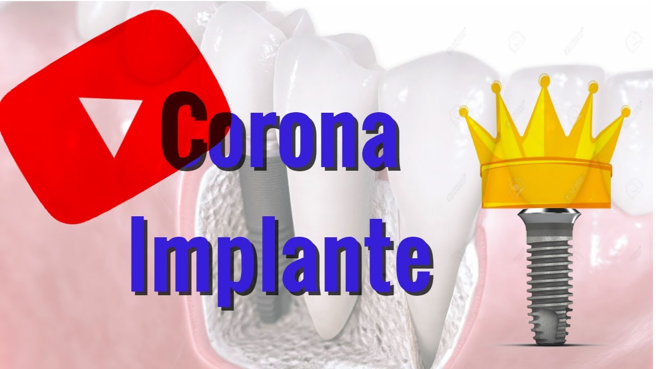 Prótesis Dental / 3shape /  Corona sobre implante