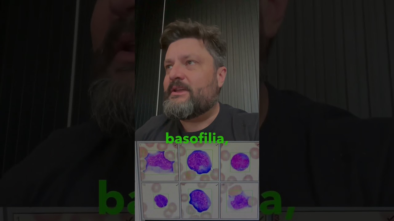 Linfocito reativo ou Blasto? #analisesclinicas #biomedicina