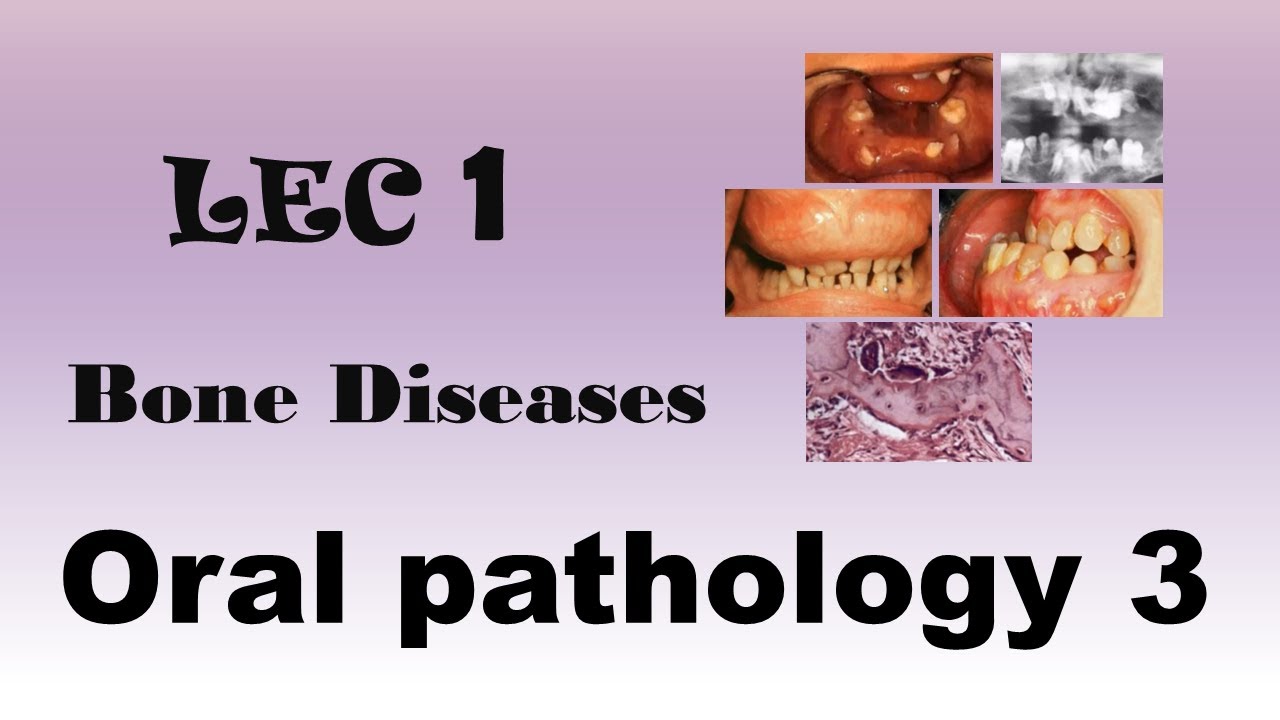 Oral Pathology 3 - LEC 1 - Bone Diseases