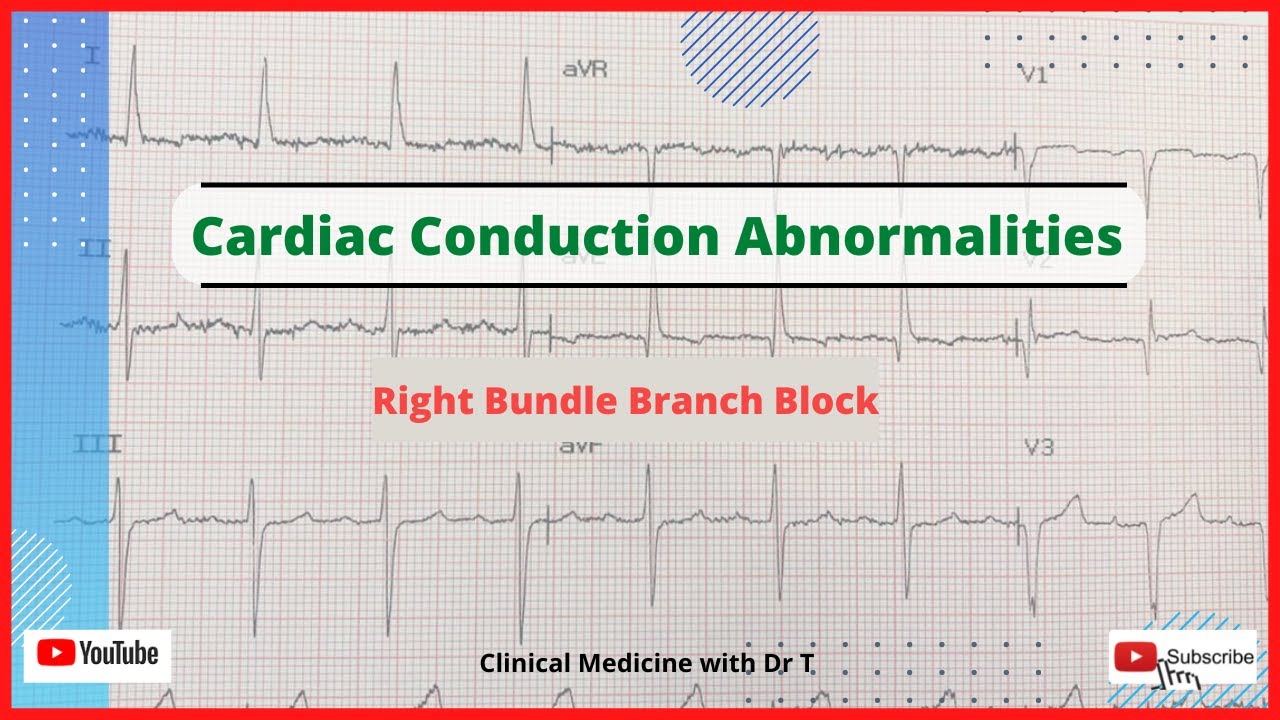 Real life ECG interpretation//Bundle Branch Block//RBBB