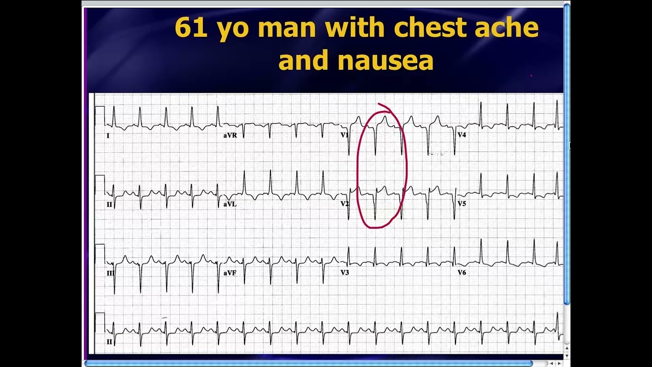 Amal Mattu's ECG Case of the Week_ Oct 28, 2013
