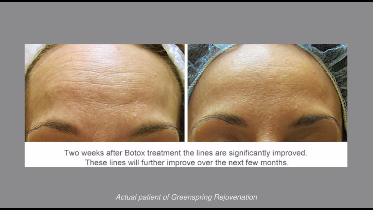 The Difference Between Botox & Fillers at Greenspring Rejuvenation in Tucson