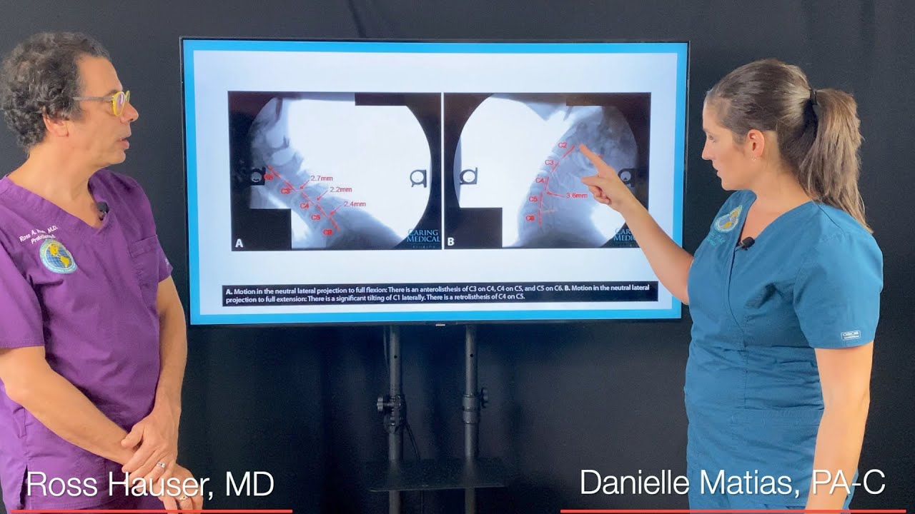 Brachioradial Pruritus treated with Prolotherapy - Patient Interview and Case Review