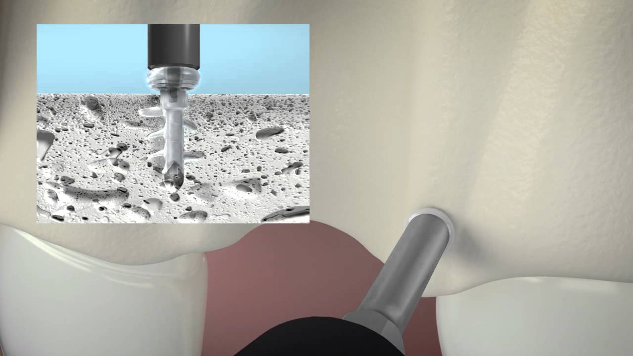 KLS - CMFRx - SonicWeld Rx Animation Alveolar 3D Foil.m4v