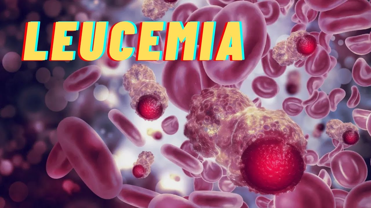 LEUCEMIAS AGUDA PEDIATRICA