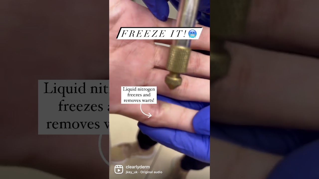 Got a wart!? Let&rsquo;s freeze it🥶!  #wartremoval #dermatology #bocaraton #skincare