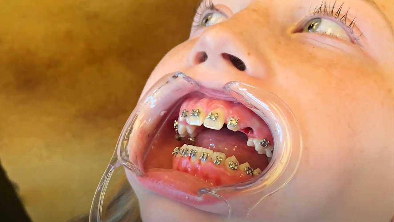 Removing a Tooth While Wearing Braces