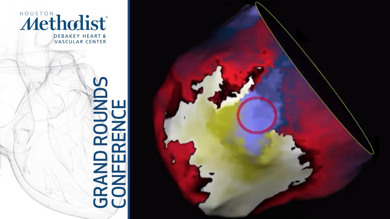 New Insights into Human VT: Anatomy & Physiology of a Public Enemy (Roderick Tung, MD) 12/03/20