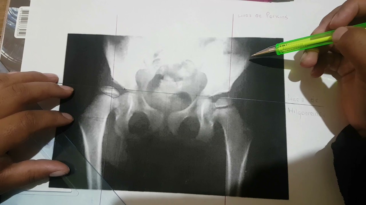 EVALUACIÓN DE PLACA RADIOGRÁFICA -DISPLASIA DE CADERA