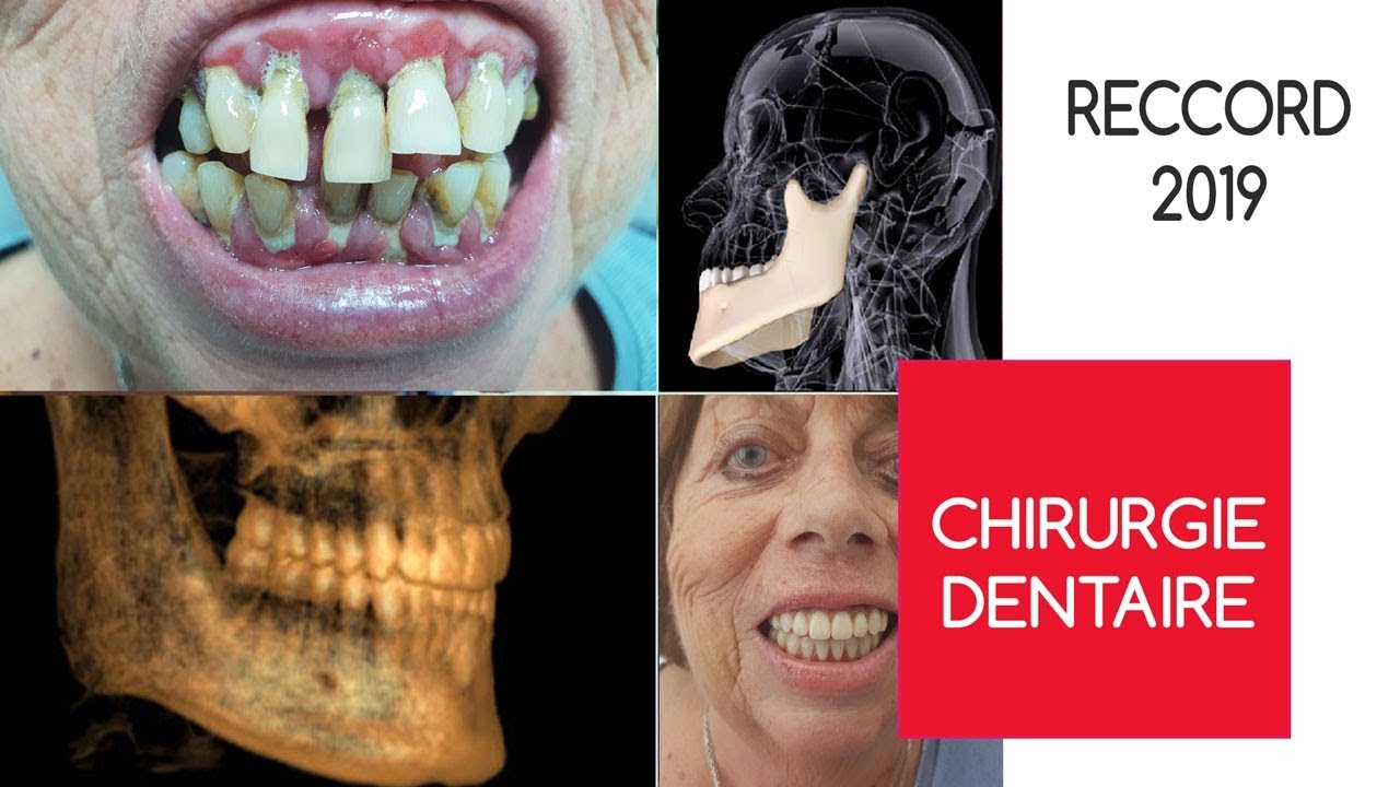 Traitement chirurgical d'une parodontite en implantologie basale - Avis
