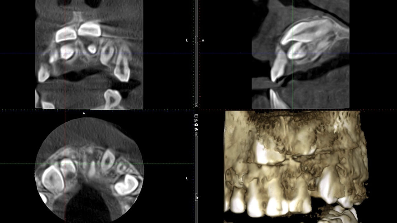 Three supernumerary teeth in ant mx