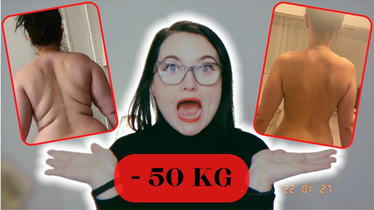 SLEEVE ⎮ 6 mois post op + mes complications