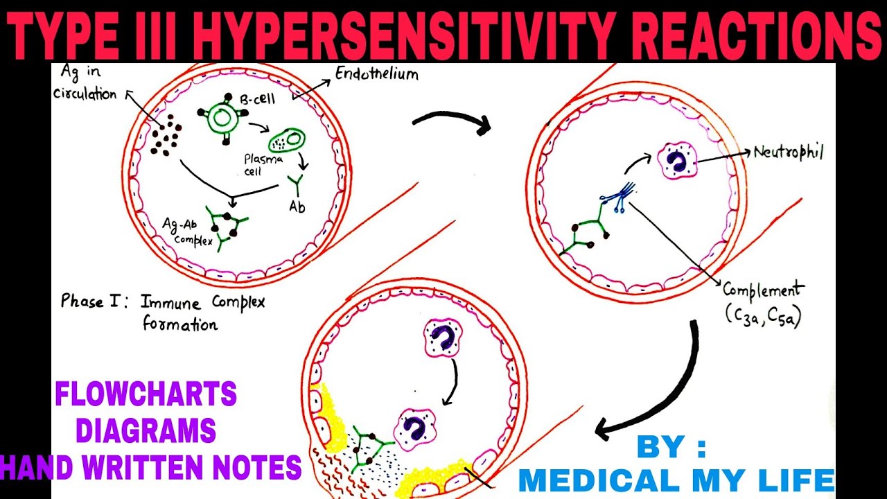Hypersensitivity ( Type 3 )